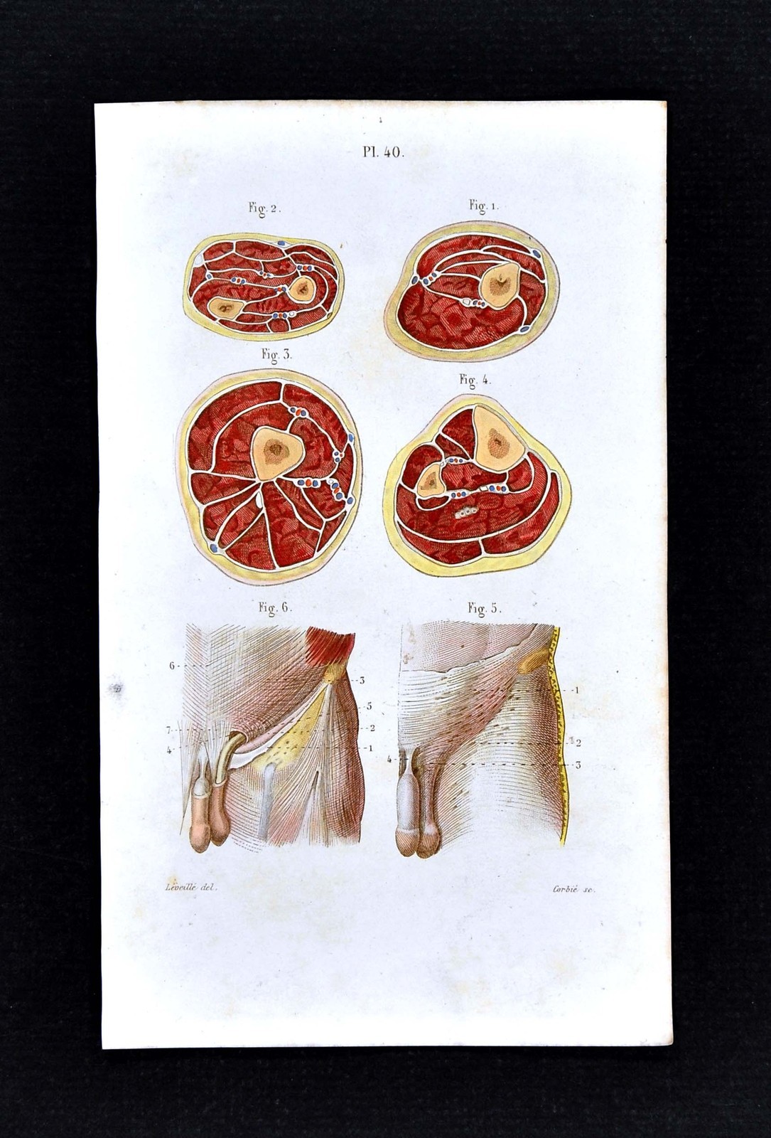 1867 Masse Human Anatomy Print – Cross Section of Arm & Thigh – Abdomen Fascia